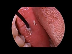 Schnarchbehandlung Radiofrequenz-Plasmagenerator mit Multifunktionssonde