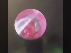 Butterfly ENT Chirurgie-Instrumente ENT-Sonde