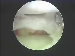 Electrosurgical-Instrument-Entfernungs-System-Entfernungs-Produkte für Dorn und Gelenke