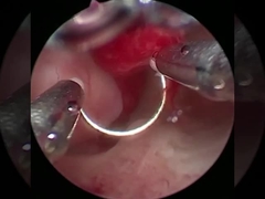 Kühle Technologie Plasma Chirurgie Elektrode für Urologie BPH Verfahren