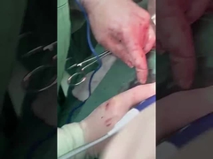 Klinische Hepatologieprobe PLA408 für offene Operationen